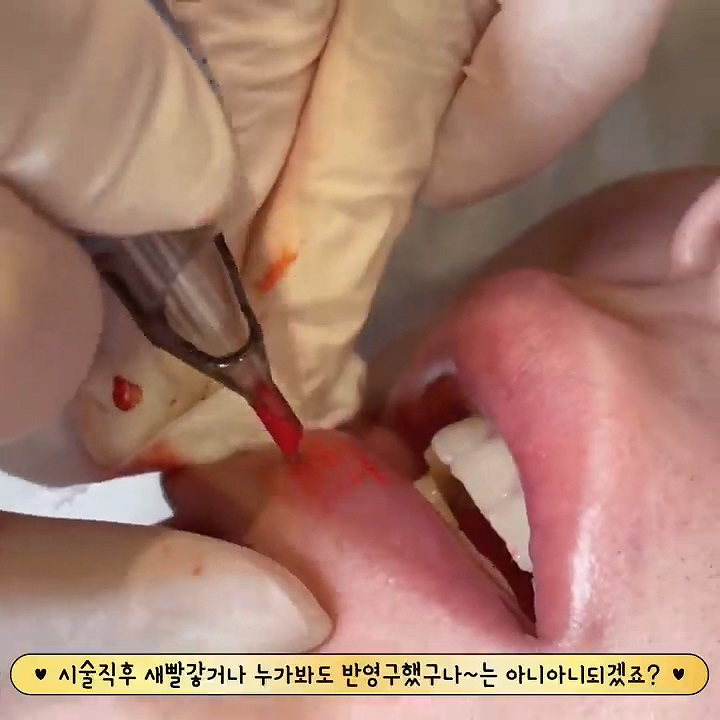  남자입술성형 말고 반영구만으로 가능! (색상/모양)