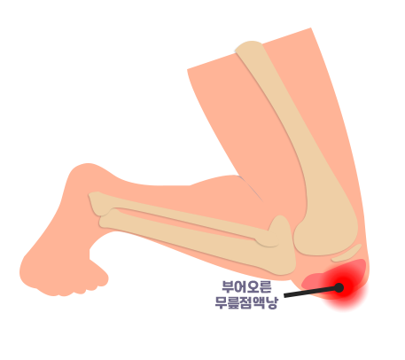 [창원마산 척추관절 디스크 365병원] 슬개골 점액낭염