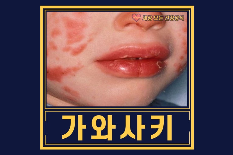  가와사키병 증상 및 원인, 치료방법 알아보기 (딸기혀, 물집, 눈충혈, 가와사키 증후군, 치료기간)