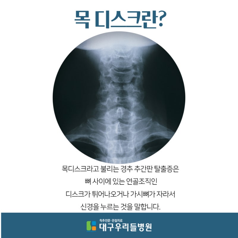 대구 월등추간판탈출증 다양한 비수술치료