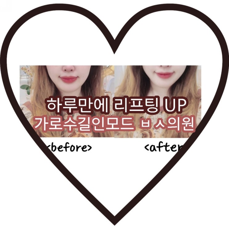  신사역 피부과 ㅂㅅ 의원 에서 인모드 받고 리프팅 업!