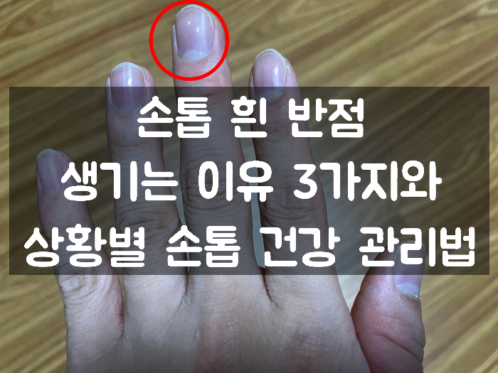  손톱 흰 반점 생기는 이유 3가지와 상황별 손톱 건강 관리법