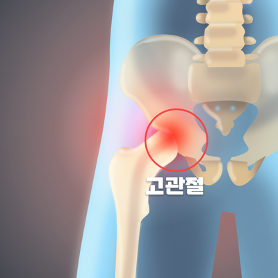  [창원마산 척추관절 디스크 365병원] 고관절 퇴행성 관절염