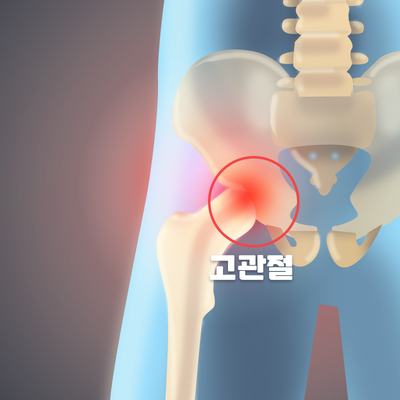 [창원마산 척추관절 디스크 365병원] 고관절 퇴행성 관절염