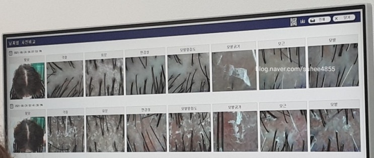  웰킨두피케어젠 인천구월점 두피관리_
