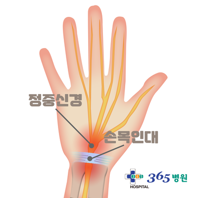  [창원마산 척추관절 디스크 365병원] 손목터널 증후군