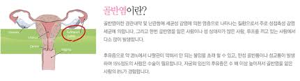 급성골반염 원인증상 약물수술치료 불임 자궁외임신 합병증 성병예방 급성골반염 원인증상 약물수술치료 불임 자궁외임신 합병증 성병예방