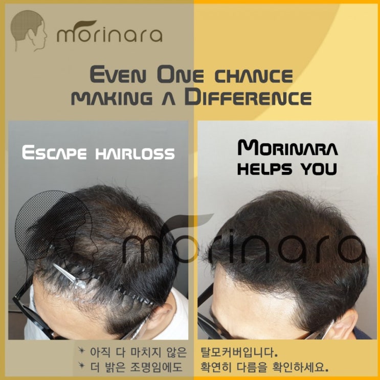  모발 이식 후 밀도보강을 위해 경기도에서  강서두피문신 을 찾다