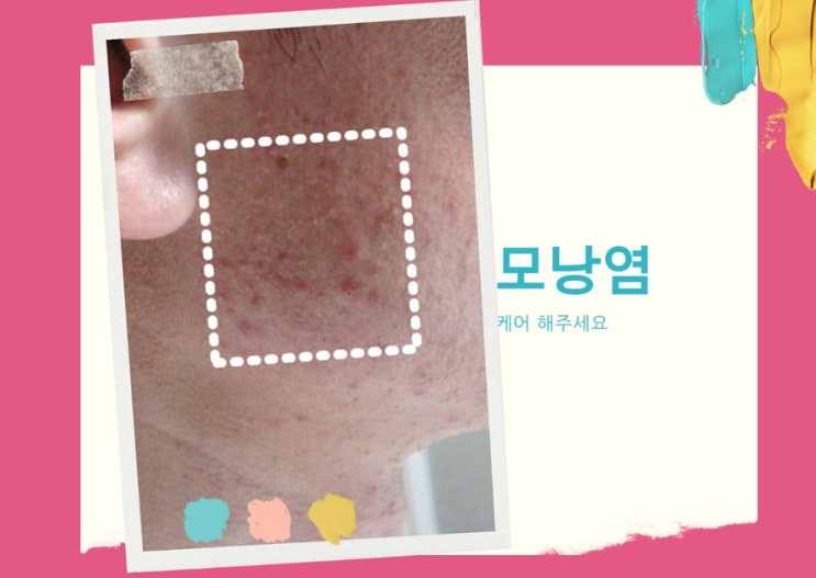 모낭염 연고 에스로반 모낭염 비누 다 피부에 쓰니 달랐어요 ! 모낭염 연고 에스로반 모낭염 비누 다 피부에 쓰니 달랐어요 !