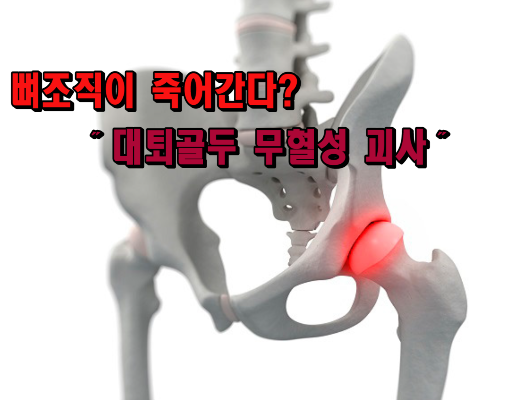  뼈조직이 죽는다.｜대퇴골두 무혈성 괴사 원인과 증상, 치료법은?
