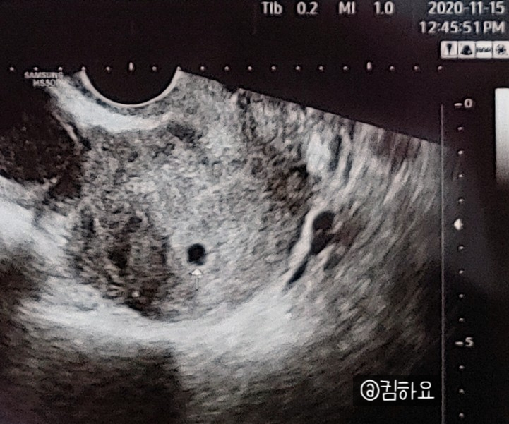  임신테스트 : 임신테스트기, 소변검사, 혈액검사, 초음파검사