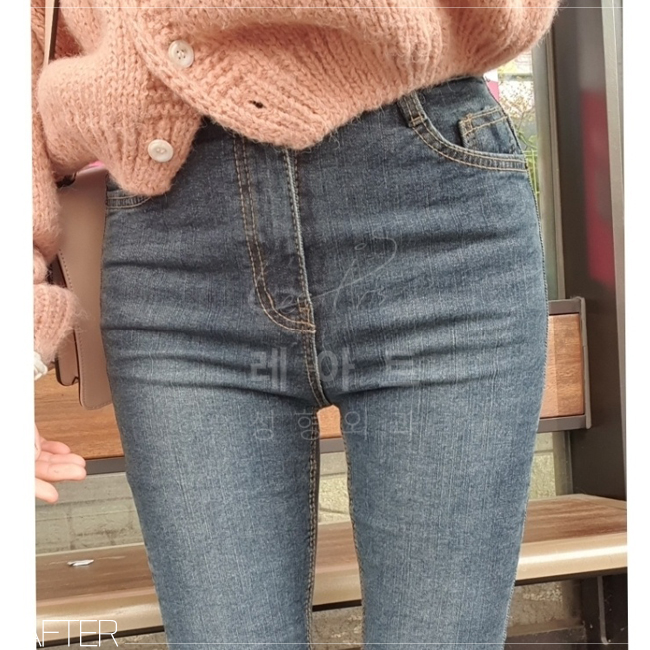  근육형 허벅지 3600cc 지방흡입