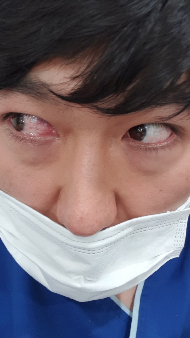 각막 상처 증상과 치료 미란 찢어짐으로 인한 각막염 각막 상처 증상과 치료 미란 찢어짐으로 인한 각막염