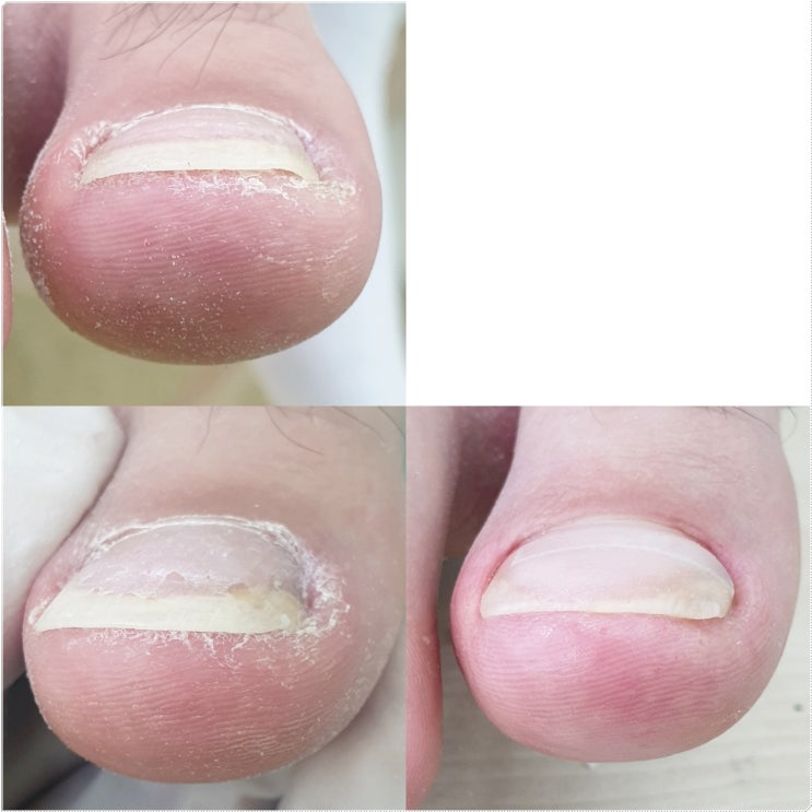  김포 내성발톱, 무좀발톱, 발각질 꼼꼼한 오직당신 풋앤네일 후기!