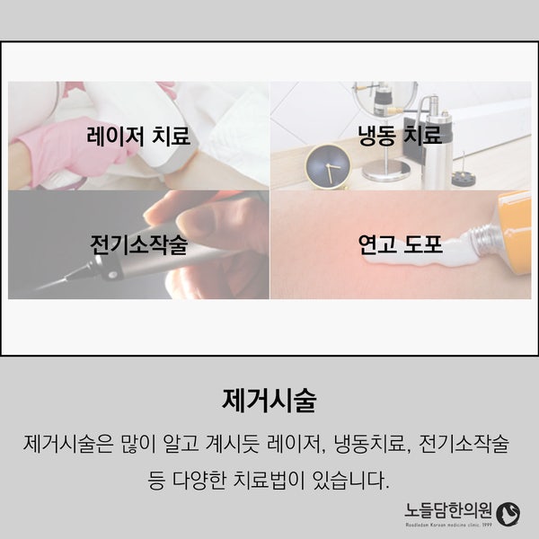 두피 사마귀 지켜만 보지 말고 치료를 받아야 합니다. : 네이버 블로그 두피 사마귀 지켜만 보지 말고 치료를 받아야 합니다. : 네이버 블로그