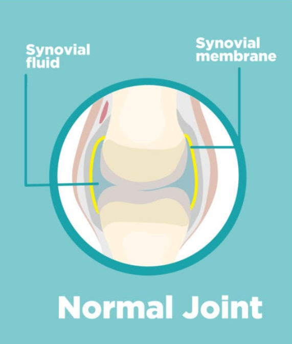 Swelling, Edema, Effusion 모두 부종?인가 차이가 있을까? 왜 다르게 쓸까 : 네이버 블로그