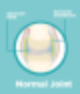 Swelling, Edema, Effusion 모두 부종?인가 차이가 있을까? 왜 다르게 쓸까 : 네이버 블로그