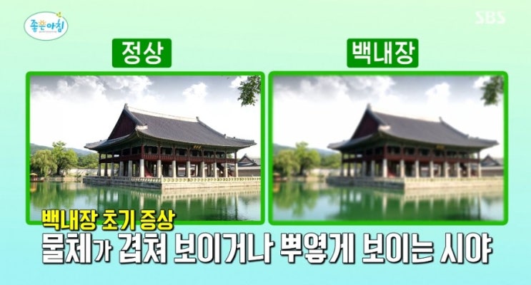  백내장 초기 증상 노안과 차이(ft. 건강한 눈 유지 방법 자가 진단법) 시야가 흐릿 답답 이중으로 사물이 겹쳐 보임