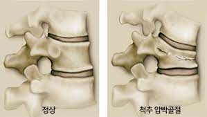 간호학 척추골절 경추요추골절 원인진단검사 응급처치 약물수술치료 신경손상 문헌고찰 간호학 척추골절 경추요추골절 원인진단검사 응급처치 약물수술치료 신경손상 문헌고찰
