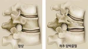 간호학 척추골절 경추요추골절 원인진단검사 응급처치 약물수술치료 신경손상 문헌고찰