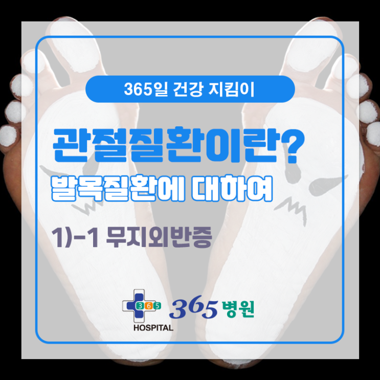  [창원마산 척추관절 디스크 365병원] 무지외반증