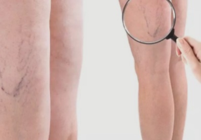  하지정맥류 초기증상 및 원인 치료방법