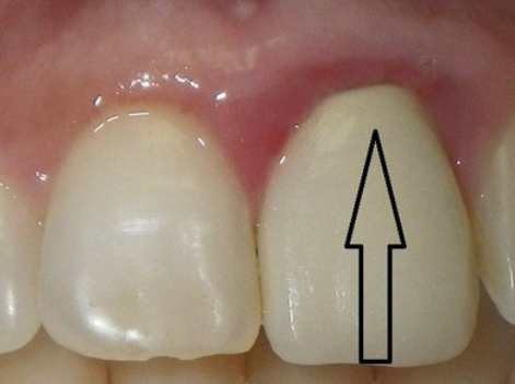 치은염의 고름에 대처하는 방법 9