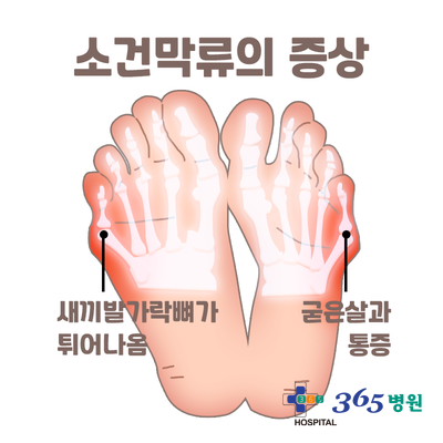  [창원마산 척추관절 디스크 365병원] 소건막류