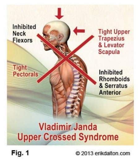  [이수역필라테스] 내가 둥근어깨와 거북목이라면? 상지교차증후군 ( Upper Crossed Syndrome ) 관련 편