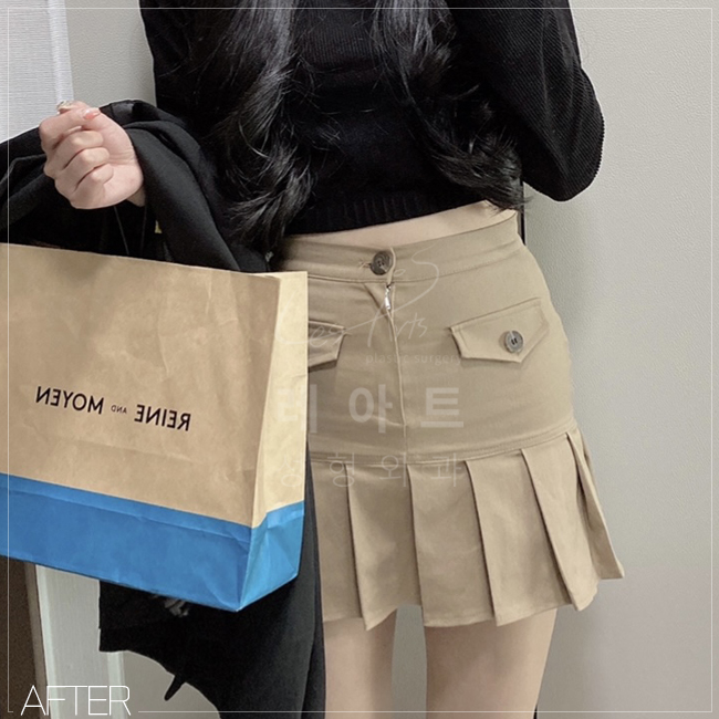  근육형 허벅지 지방흡입