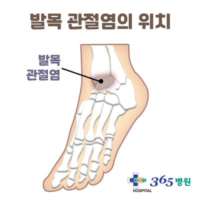  [창원마산 척추관절 디스크 365병원] 발목관절염