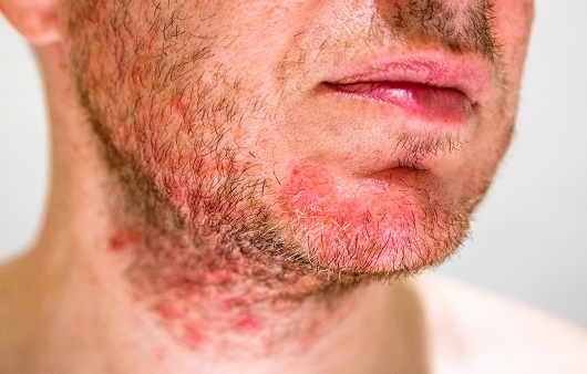 여드름 vs 지루성피부염의 차이 / 지루성 피부염 치료 관리법