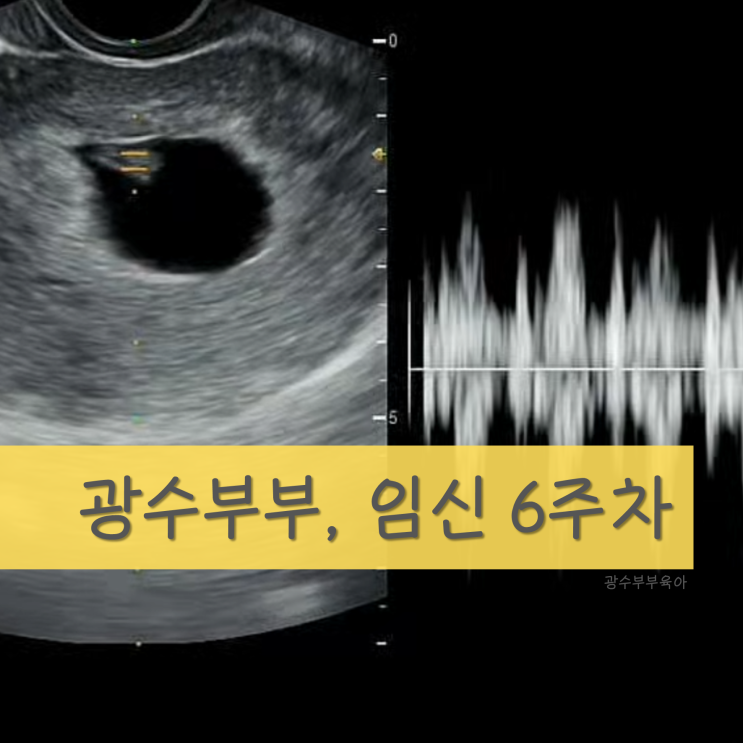 [육아] 임신 6주차 : 아기 심장소리/난황 : 초음파로 보는 감격!