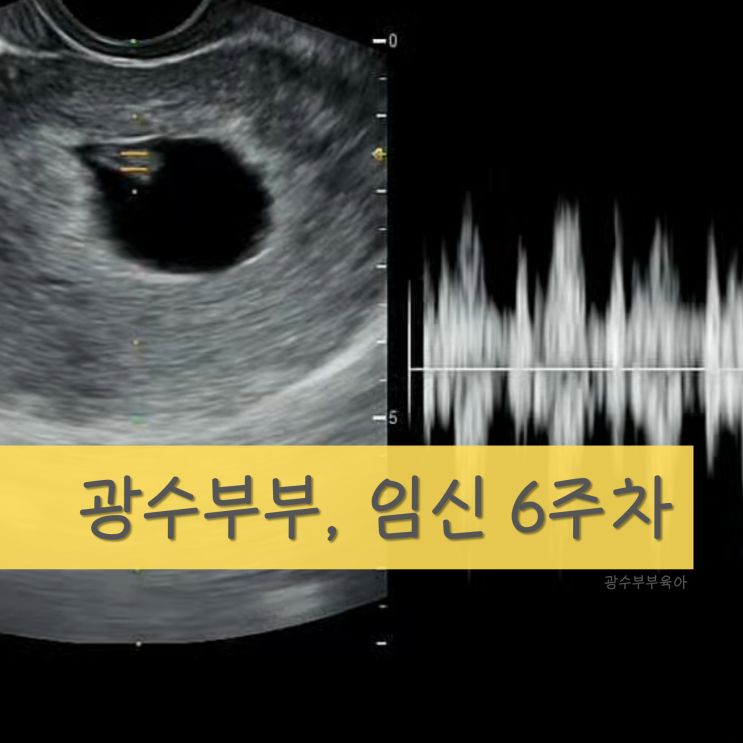  [육아] 임신 6주차 : 아기 심장소리/난황 : 초음파로 보는 감격!