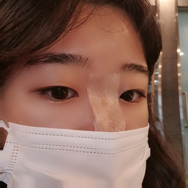  광화문 피부과에서 매부리코 필러 일주일 후기
