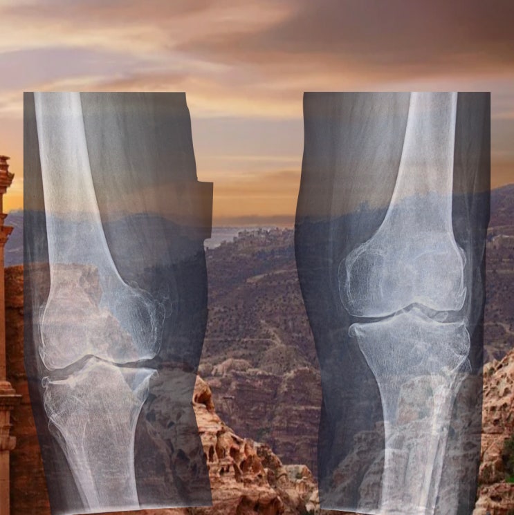 대구무릎통증 오다리 엑스다리와 관련이 있죠.