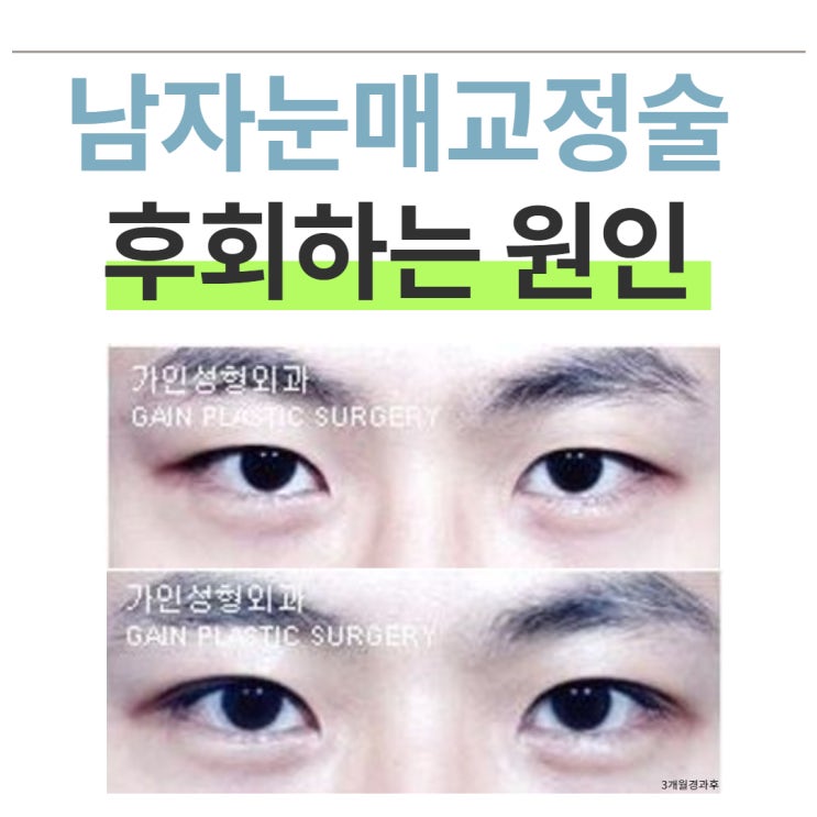  남자눈매교정술 후회하는 원인