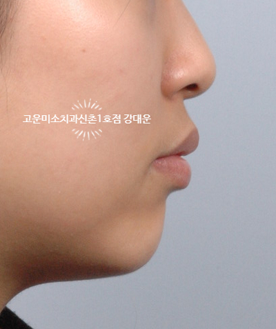  [성인교정] 돌출입, 발치 교정치료