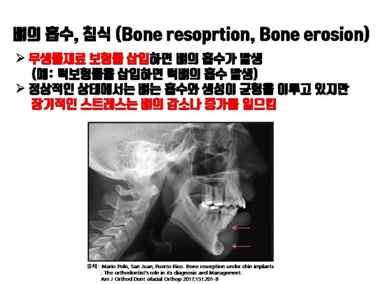  코수술 후 코보형물 제거하면 코뼈의 흡수도 코수술 전 모양으로 완전히 돌아가지 못하게 하는 원인이 될 수 있죠.