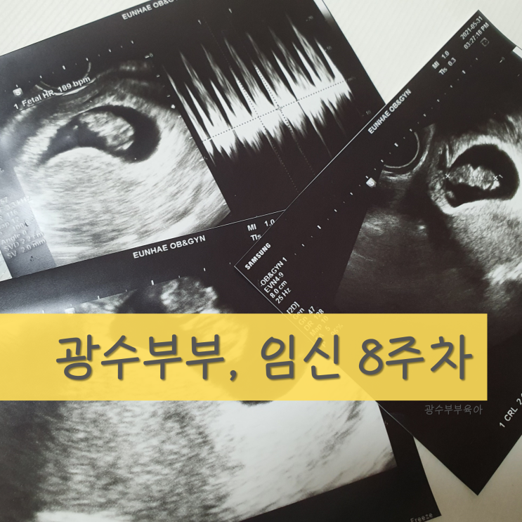 [육아] 임신 8주차 : 산부인과 정기검진 : 젤리 사이즈 태아