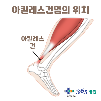  [창원마산 척추관절 디스크 365병원] 아킬레스건염