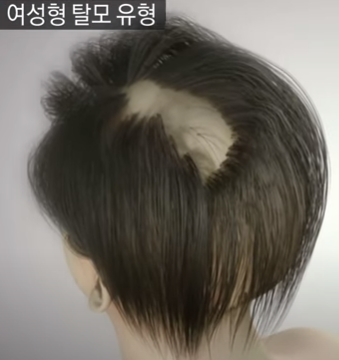  탈모의 초기 정보부터 예방까지.
