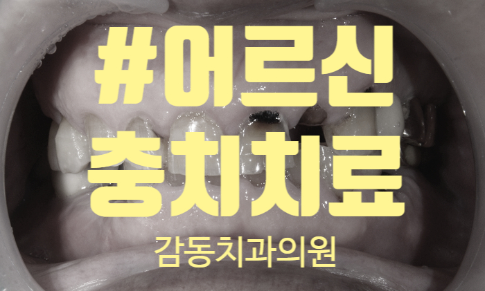  당감동 감동치과 어르신 앞니 충치치료
