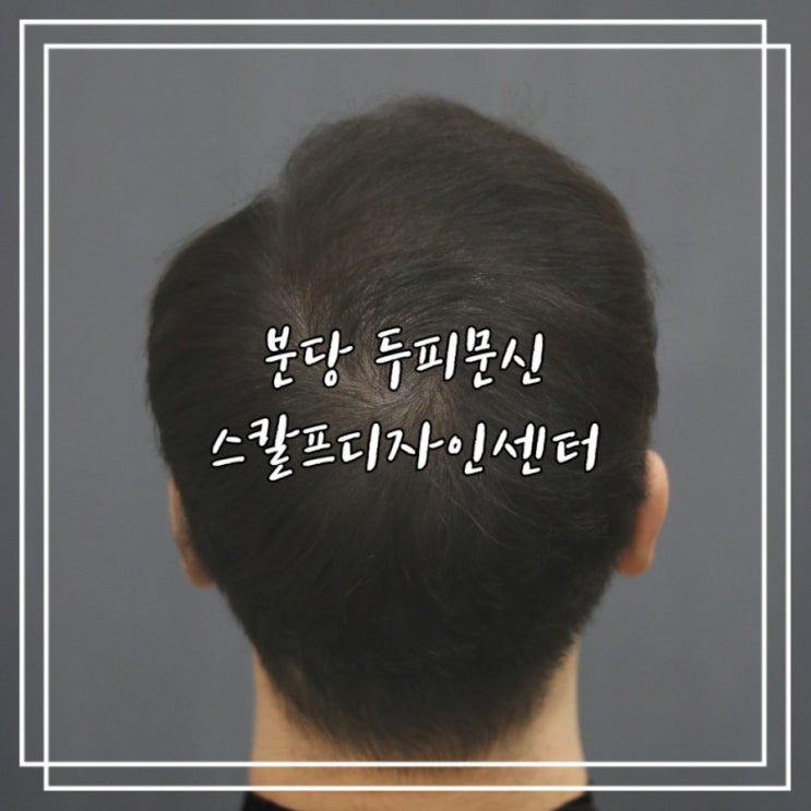  분당 두피문신 솔직후기 :: 스칼프디자인센터