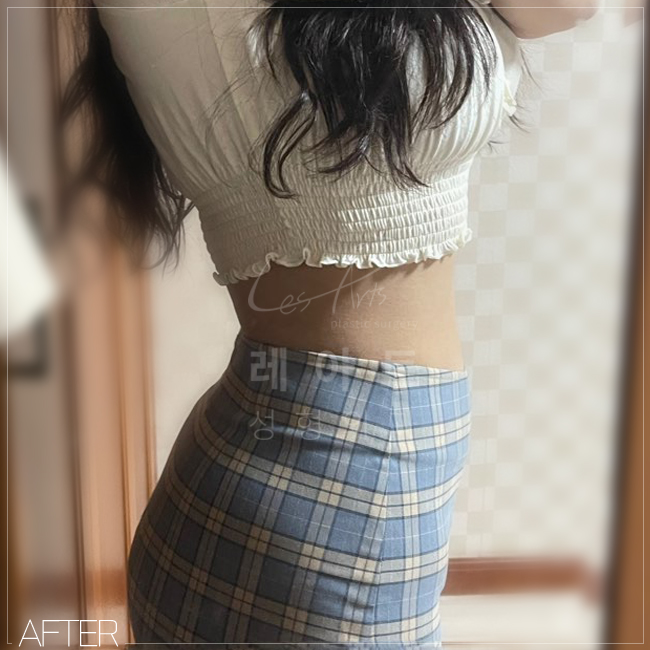  레아트성형외과 복부지방흡입