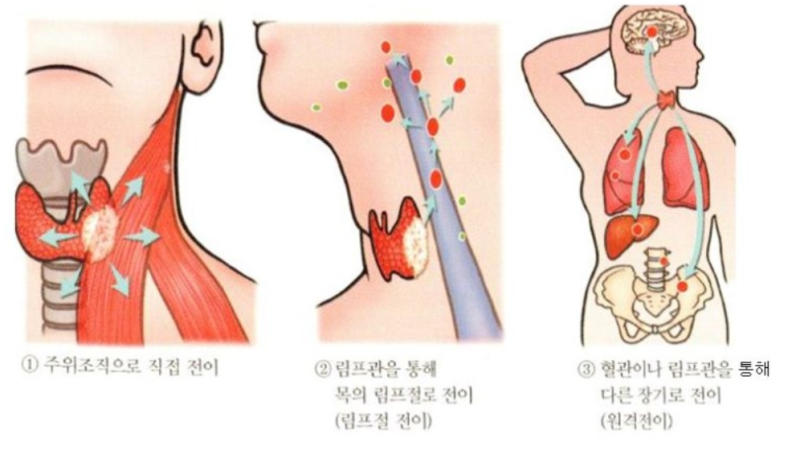갑상선암 림프절 전이암 보험금 섣부른 판단은 피해주세요
