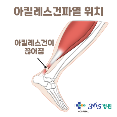  [창원마산 척추관절 디스크 365병원] 아킬레스건 파열