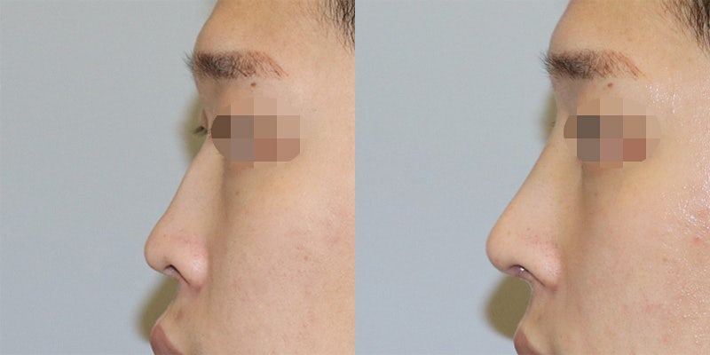 남자 매부리코수술후기_코크기 모양/너무 맘에 들어요!