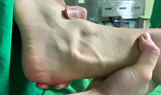  발목 탈골, 세 번 이상 삐끗하면 수술해야 된다?