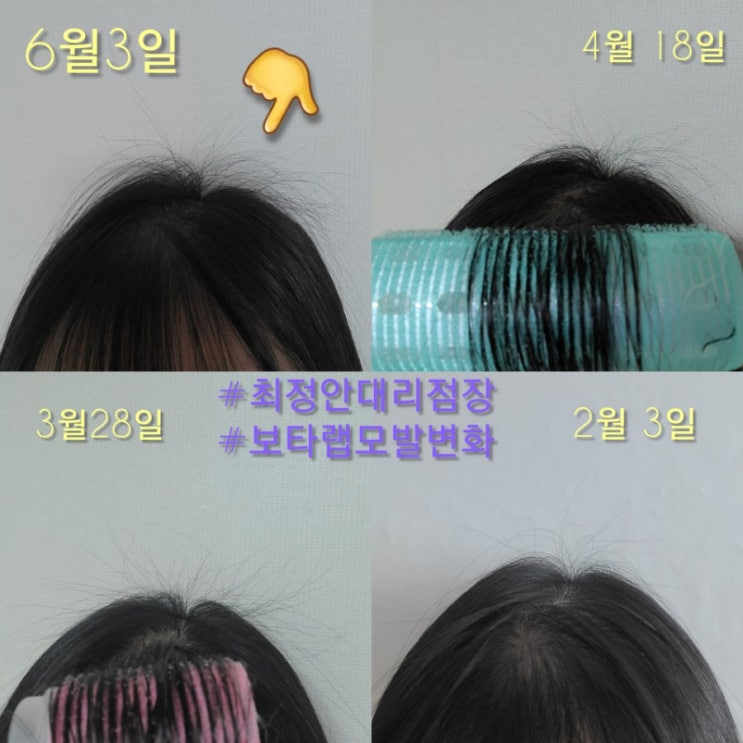 보타랩 건강한샴푸 탈모 개선 후기 (항암치료 환자 탈모 후기) 보타랩 건강한샴푸 탈모 개선 후기 (항암치료 환자 탈모 후기)